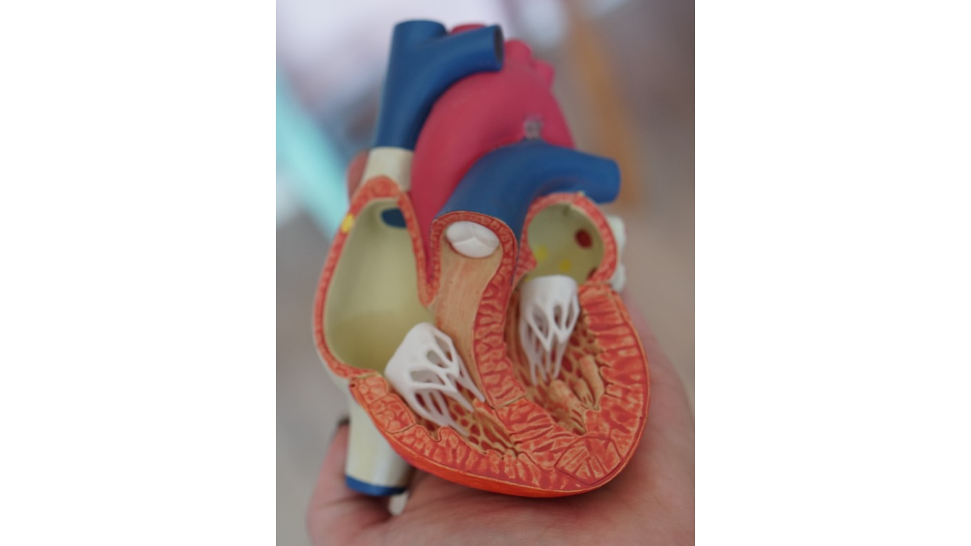 What is Supraventricular Tachycardia (SVT)?