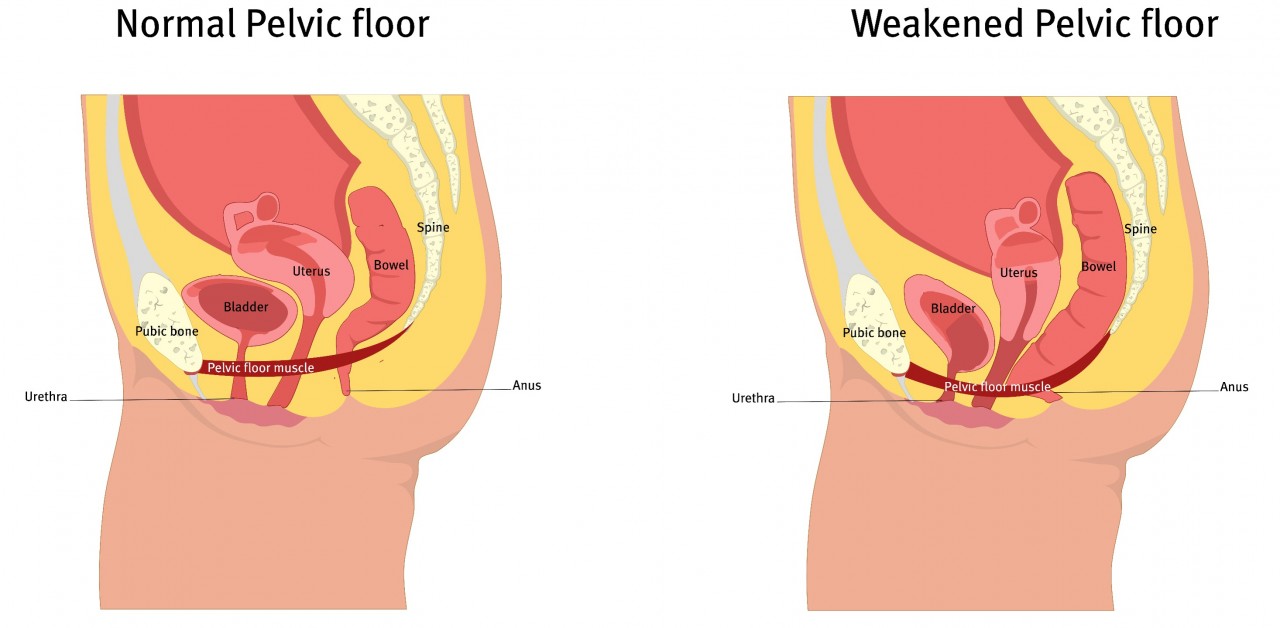 A Better Way to Treat Incontinence