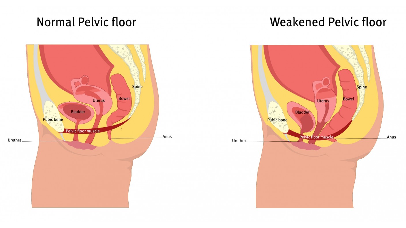 A Better Way to Treat Incontinence