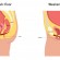 A Better Way to Treat Incontinence